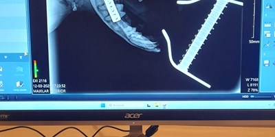 Fractura mandibular