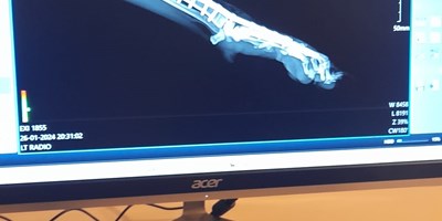 Artrodesis pancarpal 
